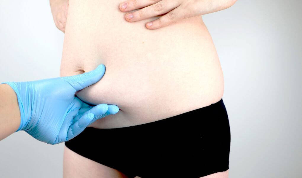 Abdominoplastia precio Sevilla