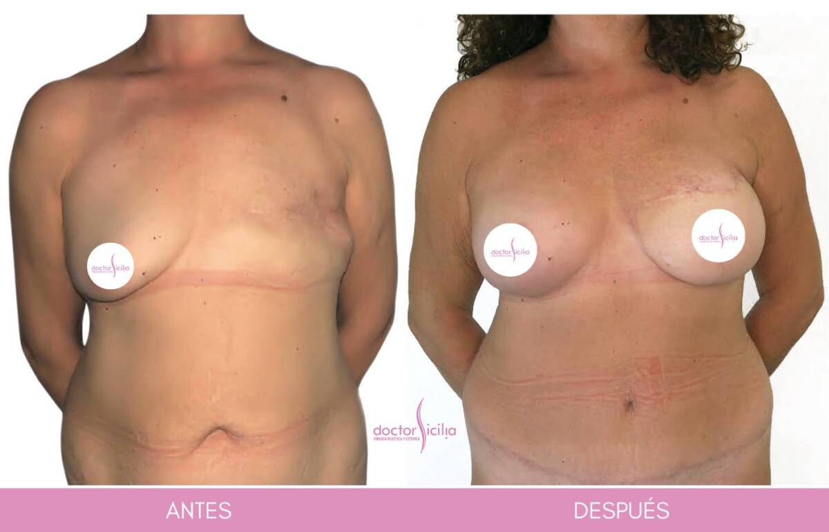 Reconstrucción mamaria híbrida (DIEP + Implante), entrevista al Dr. Sicilia y al Dr. López sobre esta técnica pionera en España 1 reconstrucción mamaria híbrida