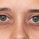 Como quitar las ojeras oscuras