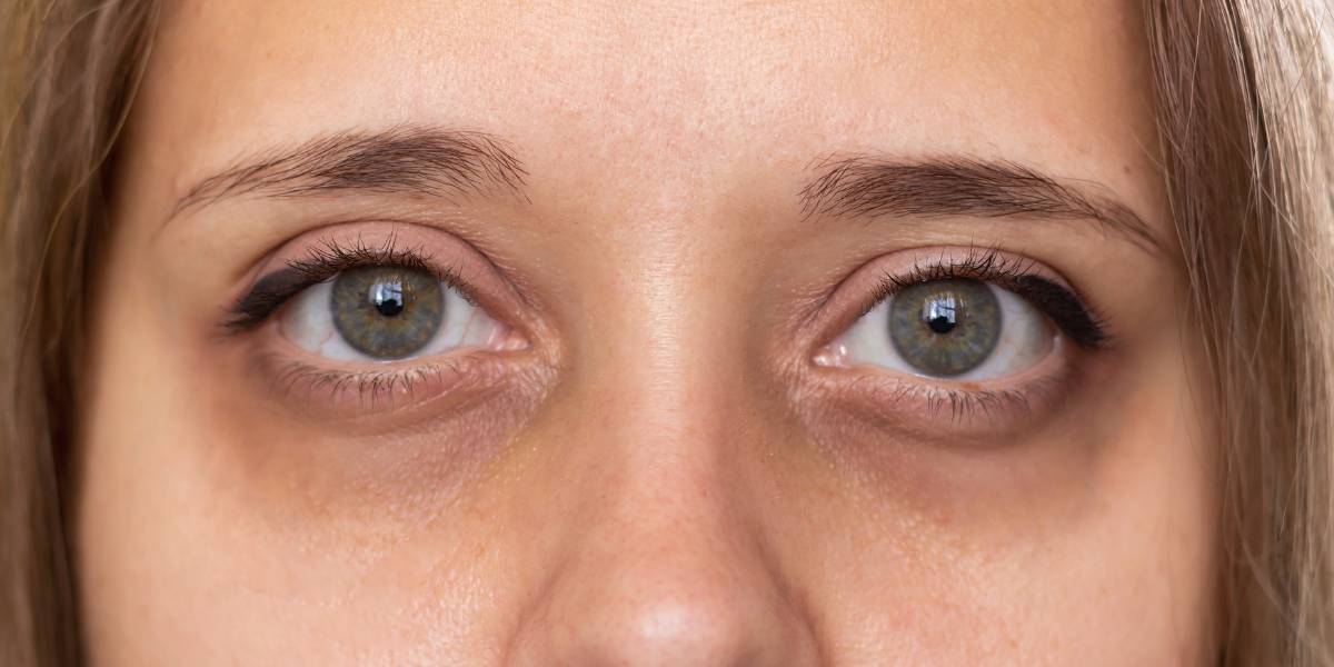 Como quitar las ojeras oscuras, tratamientos que realmente funcionan 1 Como quitar las ojeras oscuras