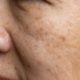 Laser en la cara para manchas