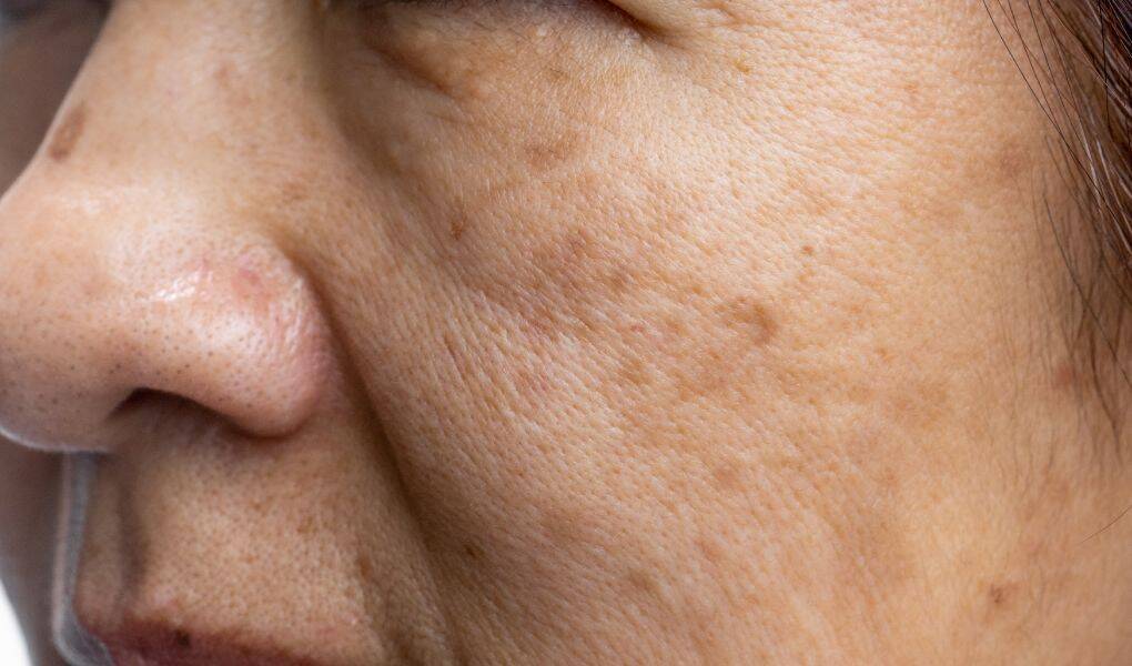 Laser en la cara para manchas, tratamiento eficaz para unificar el tono de la piel 1 Laser en la cara para manchas