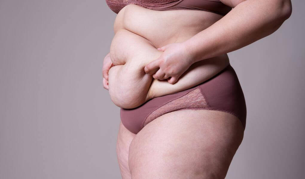 Lipedema antes y despues