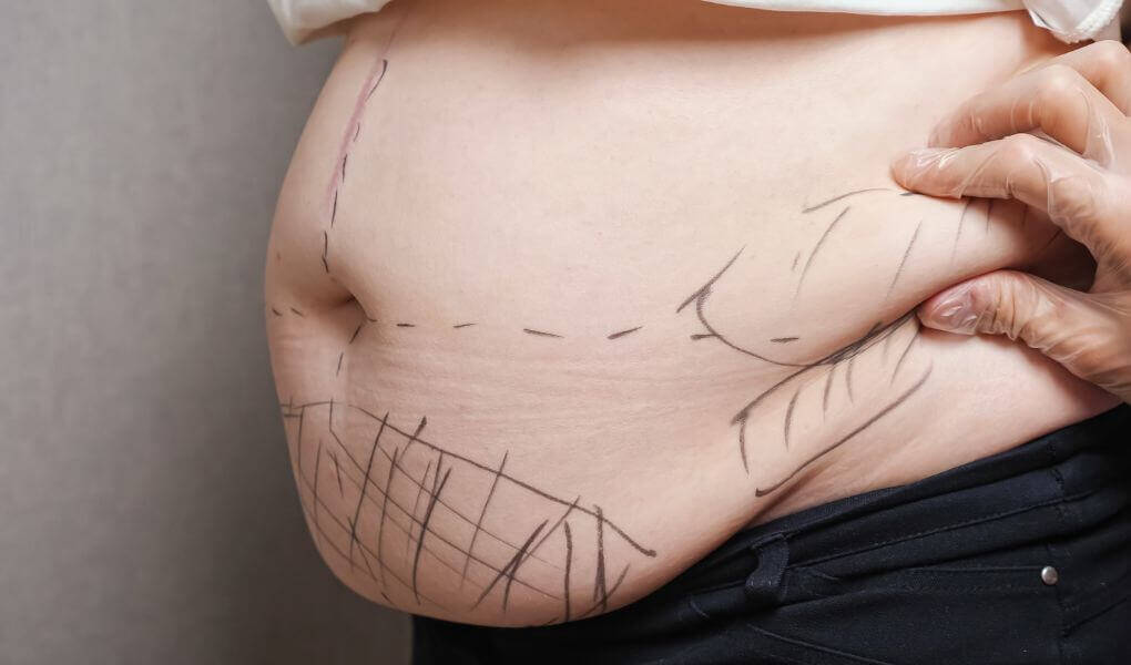 Diferencia entre Liposucción y Lipoescultura