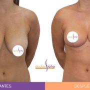 Reducción de pecho antes y después